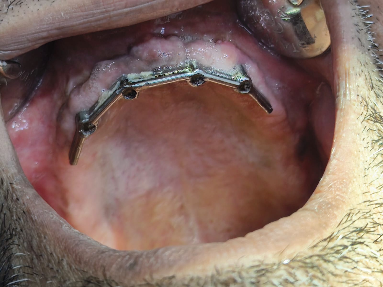 Before implant treatment